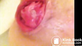 Enema prolapse and scat