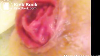 Enema prolapse and scat