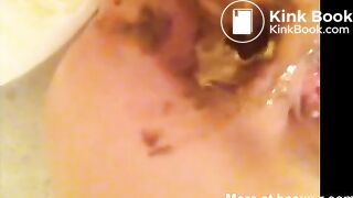 Enema prolapse and scat