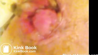 Enema prolapse and scat