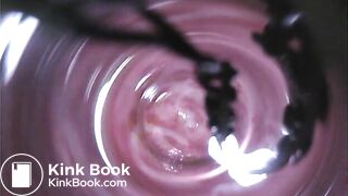 Observation　Inside Anus