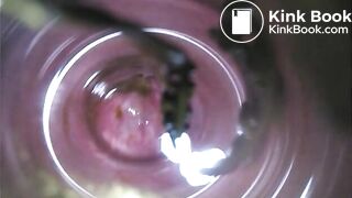 Observation　Inside Anus