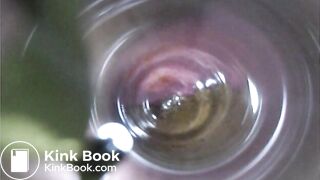 Observation　Inside Anus