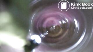 Observation　Inside Anus