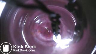 Observation　Inside Anus