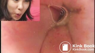 eggs and shit in the bowel