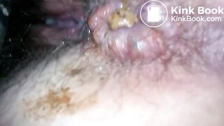 Turd stuck in her asshole