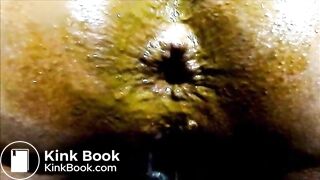 anal 2