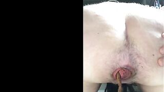 Shitting prolapse -