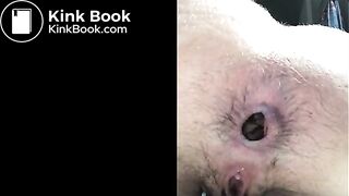 Shitting prolapse -