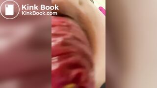 Prolapse2