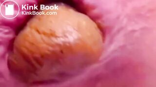 Constipated Hard Poop Fun