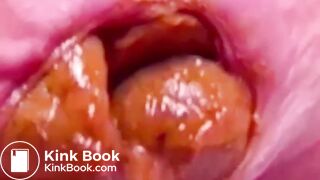 Constipated Hard Poop Fun