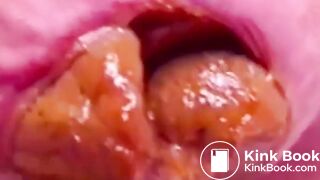 Constipated Hard Poop Fun