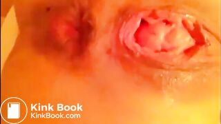 Anal self fisting prolapsed with little shit