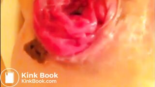 Anal self fisting prolapsed with little shit