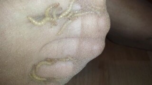 Look the Maggots eating my Toes
