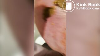 Scat From Polio Amputee Cripple