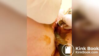 Scat urethra until anal urination