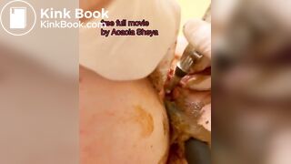 Scat urethra until anal urination