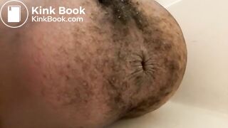 Prolapse