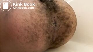 Prolapse