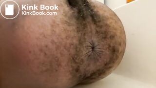 Prolapse