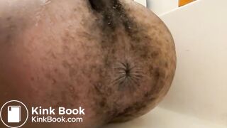 Prolapse