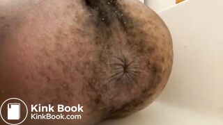 Prolapse