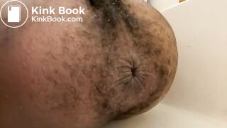 Prolapse