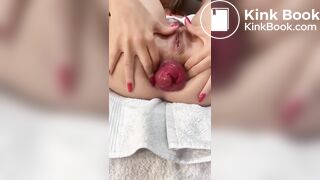 shit prolapse