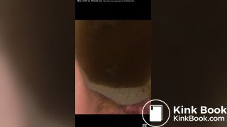 Bad day with watery diarrhea