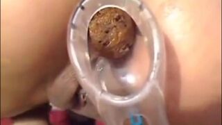 Girl Anal Speculum Shit
