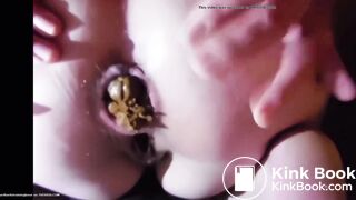 Constipated teen severe constipation struggling to poop