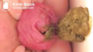 Prolapse scat - video 10