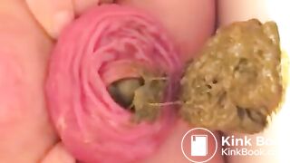 Prolapse scat - video 10