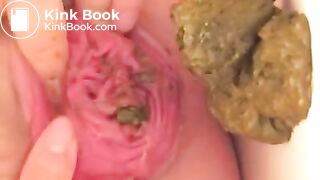 Prolapse scat - video 10