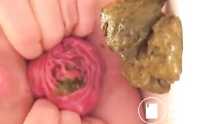 Prolapse scat - video 10