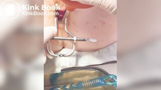 Urine sample at gyno p. 2/2B