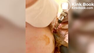 Urethra scat until anal urination