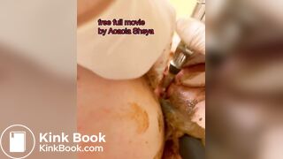 Urethra scat until anal urination