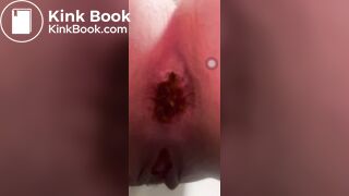 Constipation - video 12