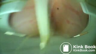 Diarrhea - video 305