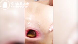 Open anus with poo close up