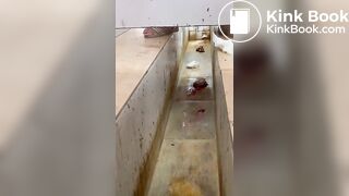 Chinese girl with large amount of diarrhea