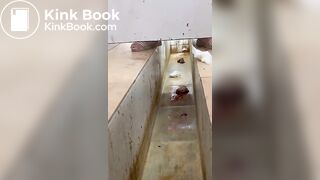 Chinese girl with large amount of diarrhea