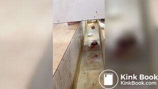 Chinese girl with large amount of diarrhea