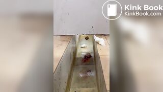 Chinese girl with large amount of diarrhea