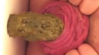 Prolapse Pro (Closeup)