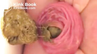 Prolapse Pro (Closeup)